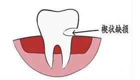 楔状缺损